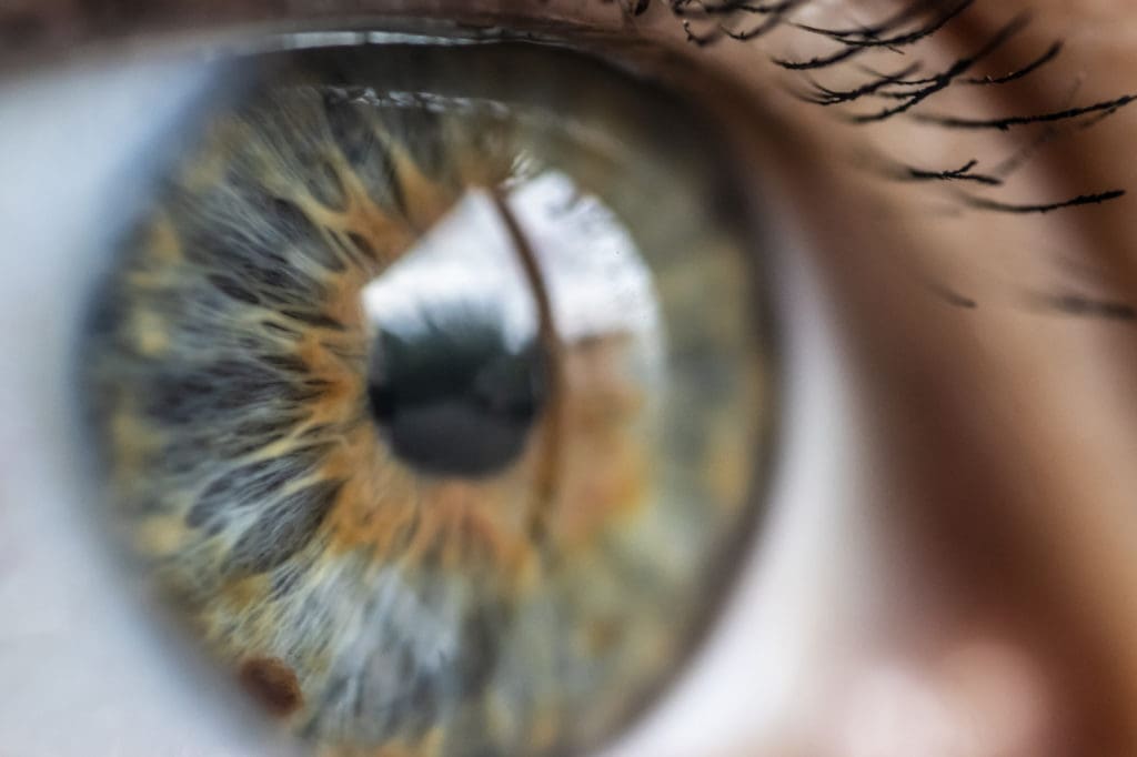 A close-up of a person's eye with an astigmatism.