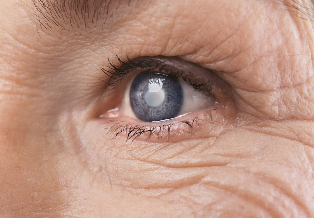 Close-up of an elderly person's eye, highlighting wrinkles, cataract symptoms, and signs of aging.