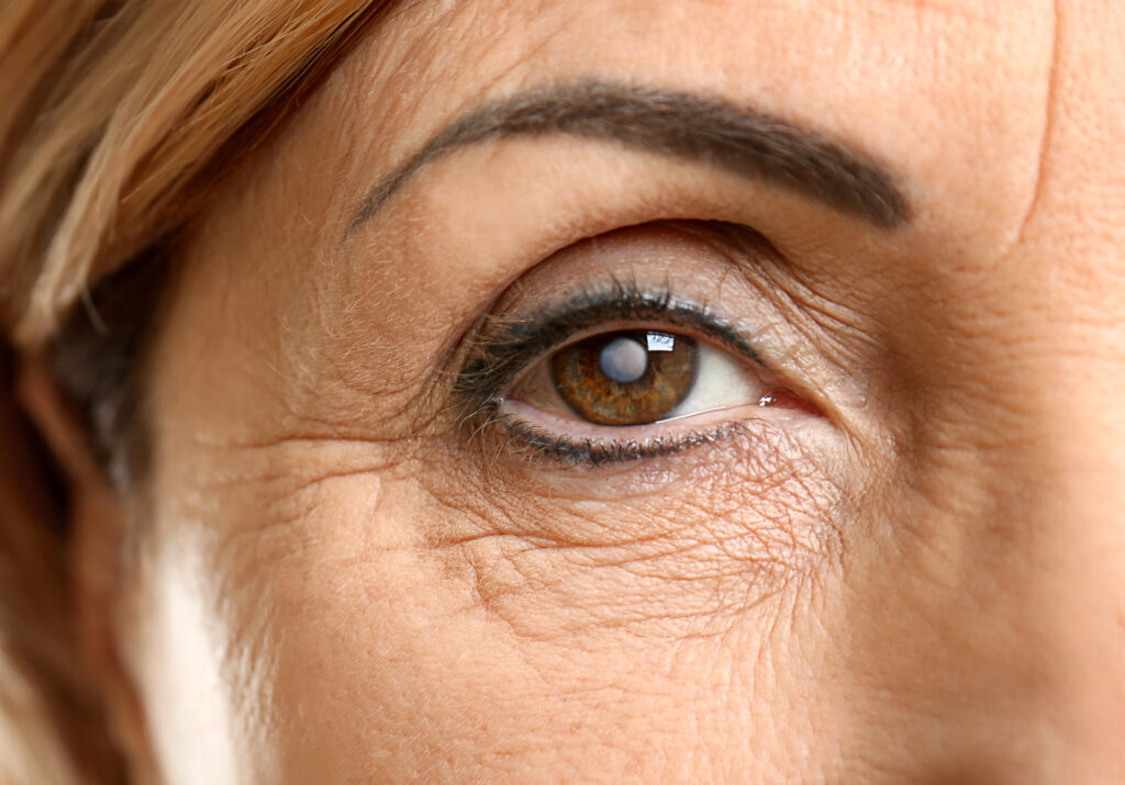 Close-up of a mature person's eye, highlighting detailed wrinkles around the area and slightly arched eyebrow. The eye, open and looking straight ahead, shows no symptoms of cataracts.