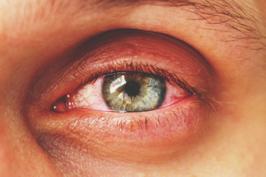 Close-up of a human eye with visible redness and inflammation around the eyelid, possibly one of the causes of burning eyes. The iris is blue-green, and the surrounding skin shows slight irritation.