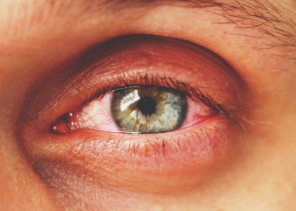 Close-up of a human eye with visible redness and inflammation around the eyelid, possibly one of the causes of burning eyes. The iris is blue-green, and the surrounding skin shows slight irritation.