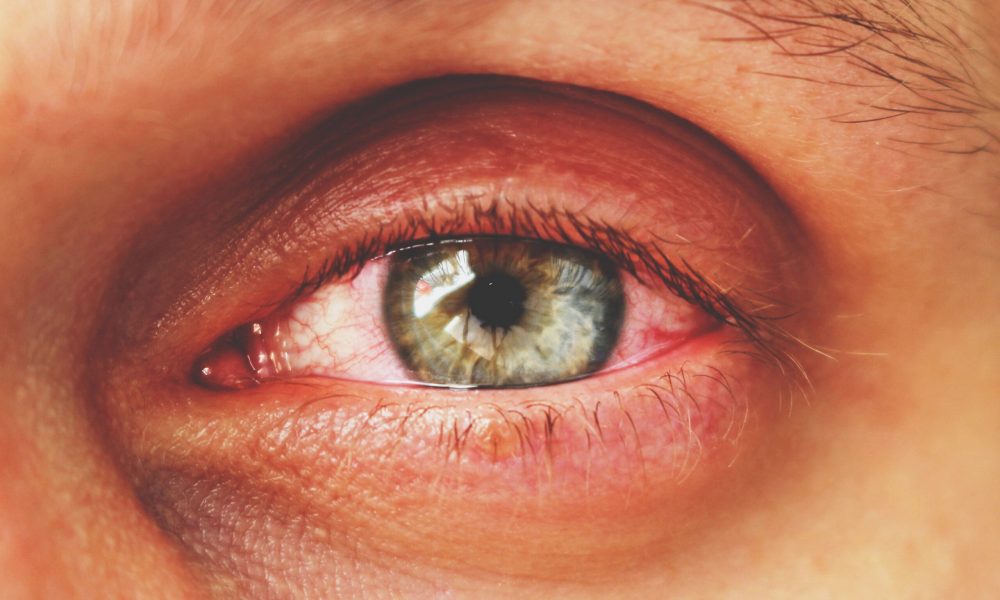 Close-up of a human eye with visible redness and inflammation around the eyelid, possibly one of the causes of burning eyes. The iris is blue-green, and the surrounding skin shows slight irritation.