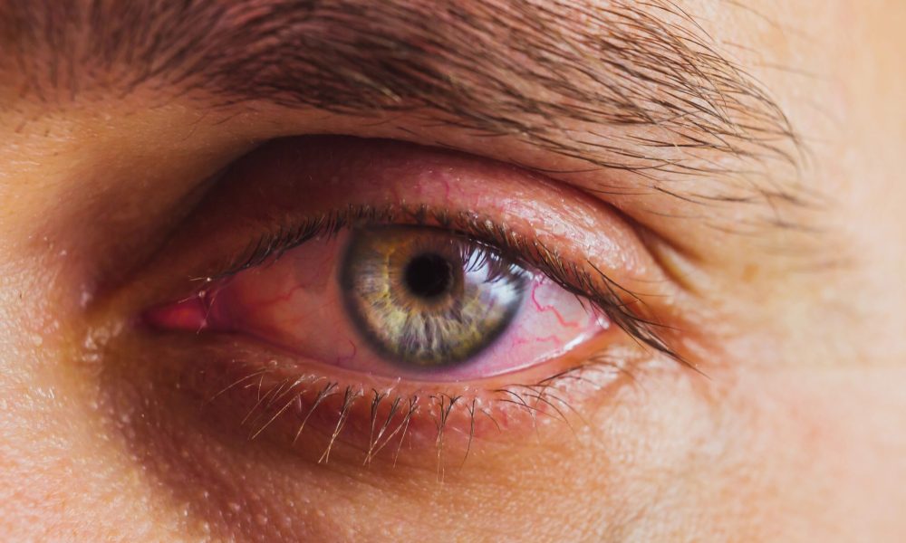 Close-up of a person's blue-green eye with visible red veins, suggesting the possibility of sore eyes. The well-defined eyebrow complements the striking detail.