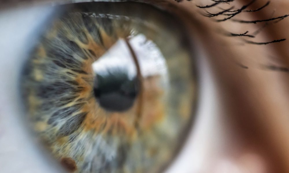 A close-up of a person's eye with an astigmatism.